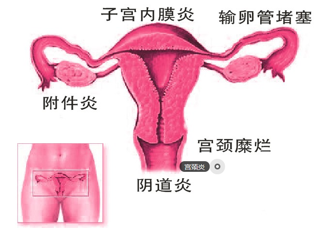 宫颈糜烂反复发作去哪个医院看才好?