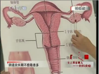 成都哪个妇科医院看阴道炎更专业?